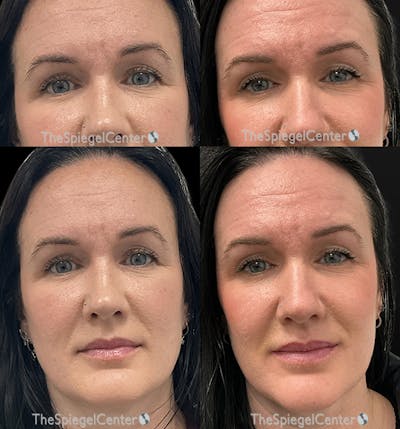 Temple Filler Before & After Gallery - Patient 140922 - Image 1