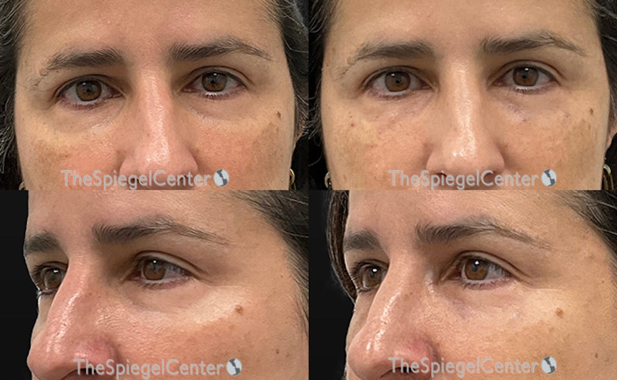 Tear Trough / Under Eye Fillers Before & After Gallery - Patient 408452 - Image 1