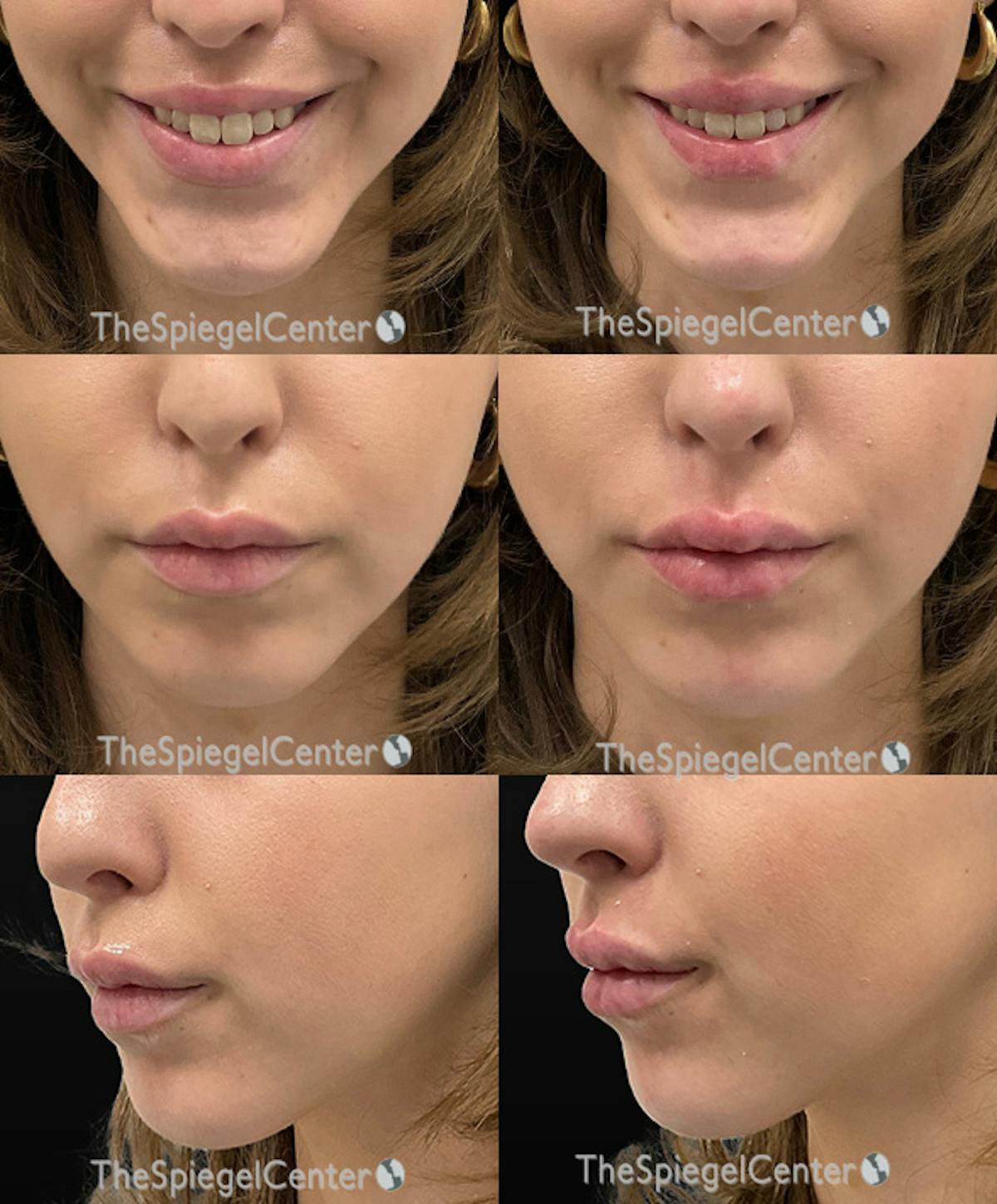 Lip Filler Before & After Gallery - Patient 208947 - Image 1