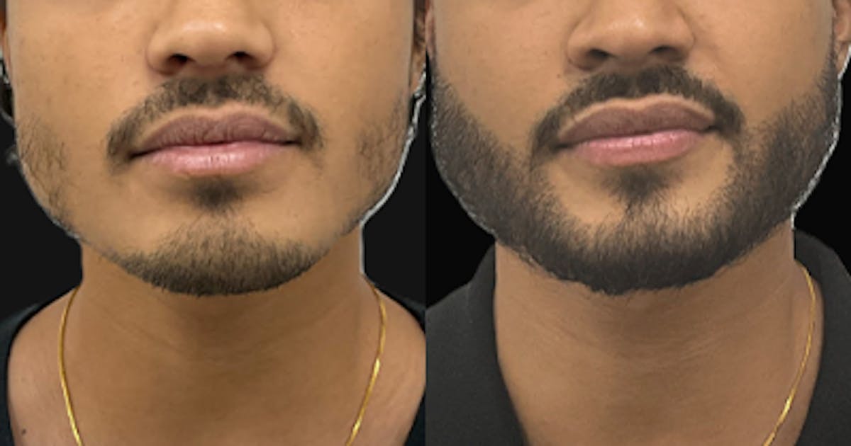 Hair Restoration Before & After Gallery - Patient 100861 - Image 1