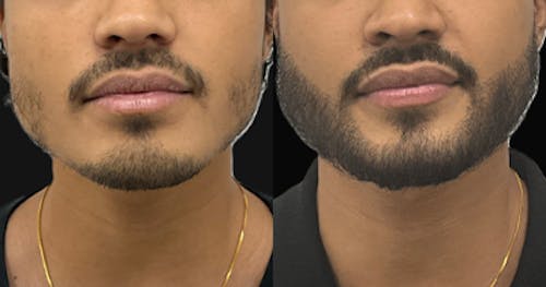 Hair Restoration Before & After Gallery - Patient 100861 - Image 1