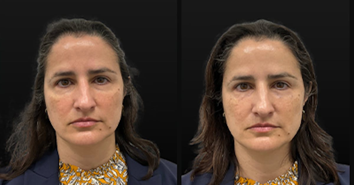Temple Filler Before & After Gallery - Patient 328736 - Image 1