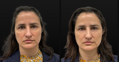 Temple Filler Before & After Gallery - Patient 328736 - Image 1