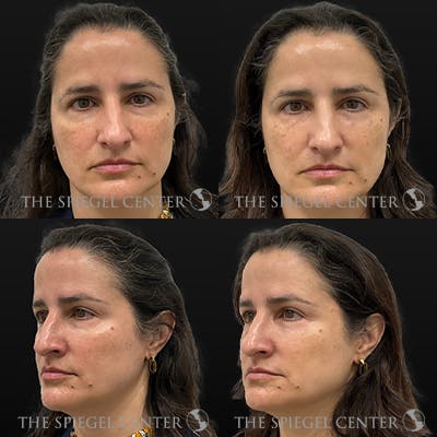 Temple Filler Before & After Gallery - Patient 328736 - Image 1