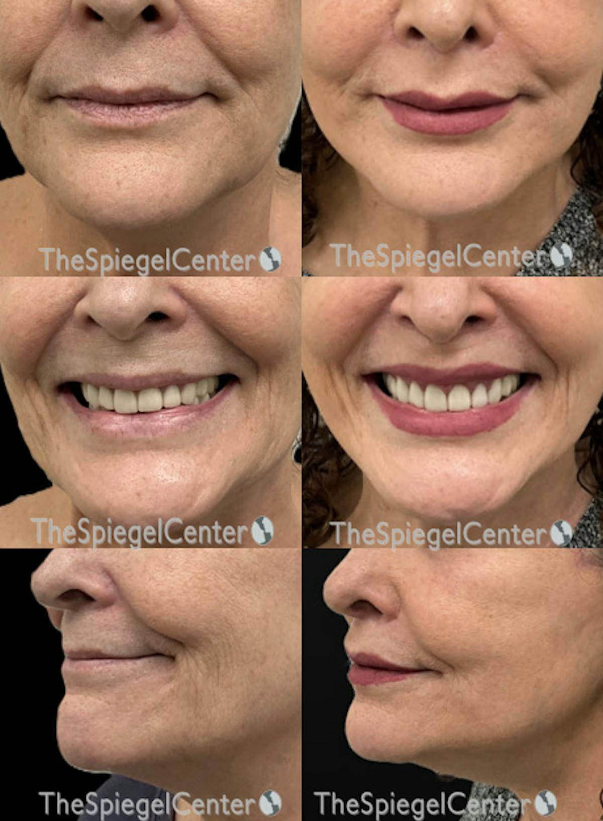 Lip Filler Before & After Gallery - Patient 268598 - Image 1