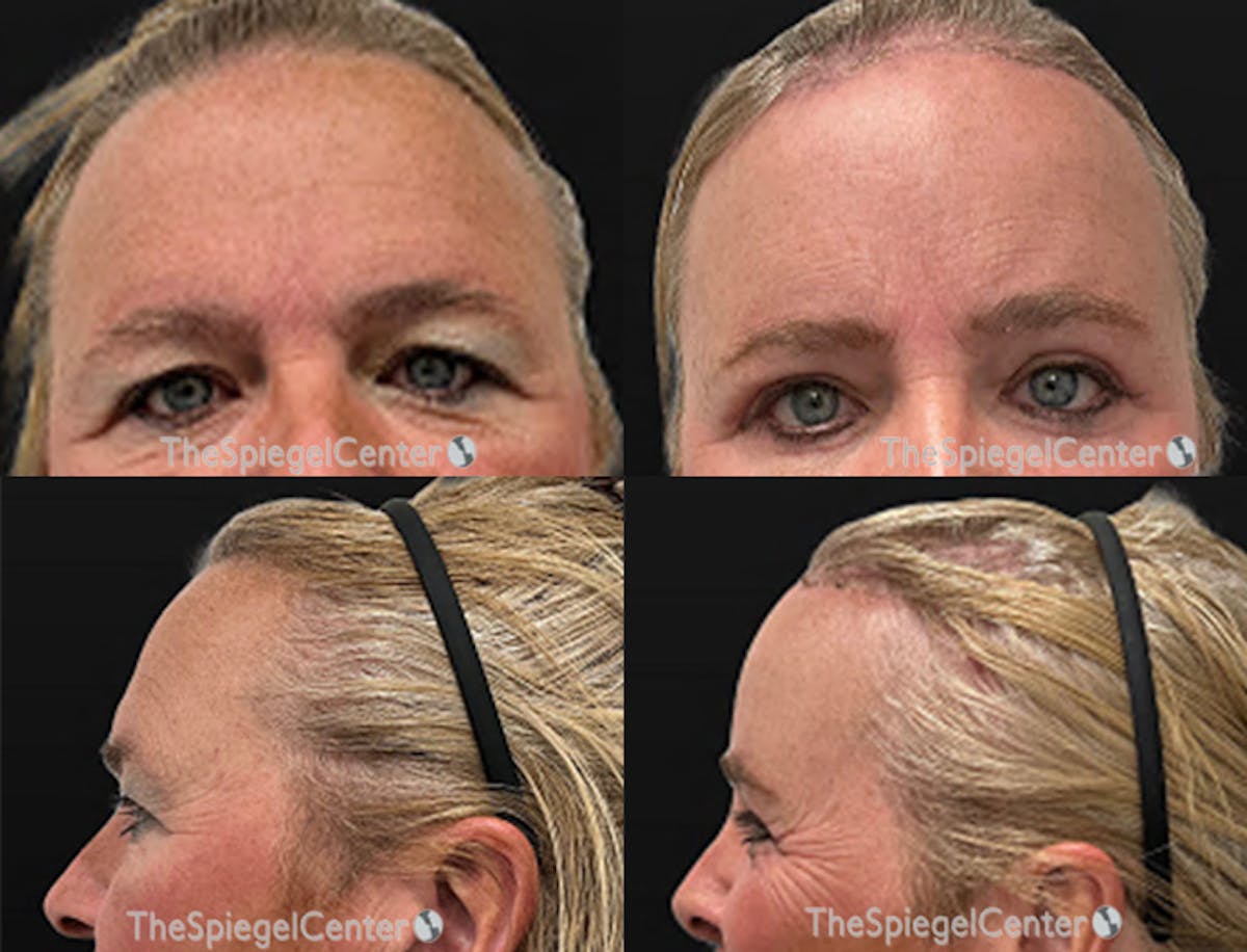 Forehead Contouring Before & After Gallery - Patient 349231 - Image 1