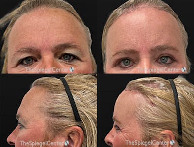 Forehead Contouring Before & After Gallery - Patient 349231 - Image 1