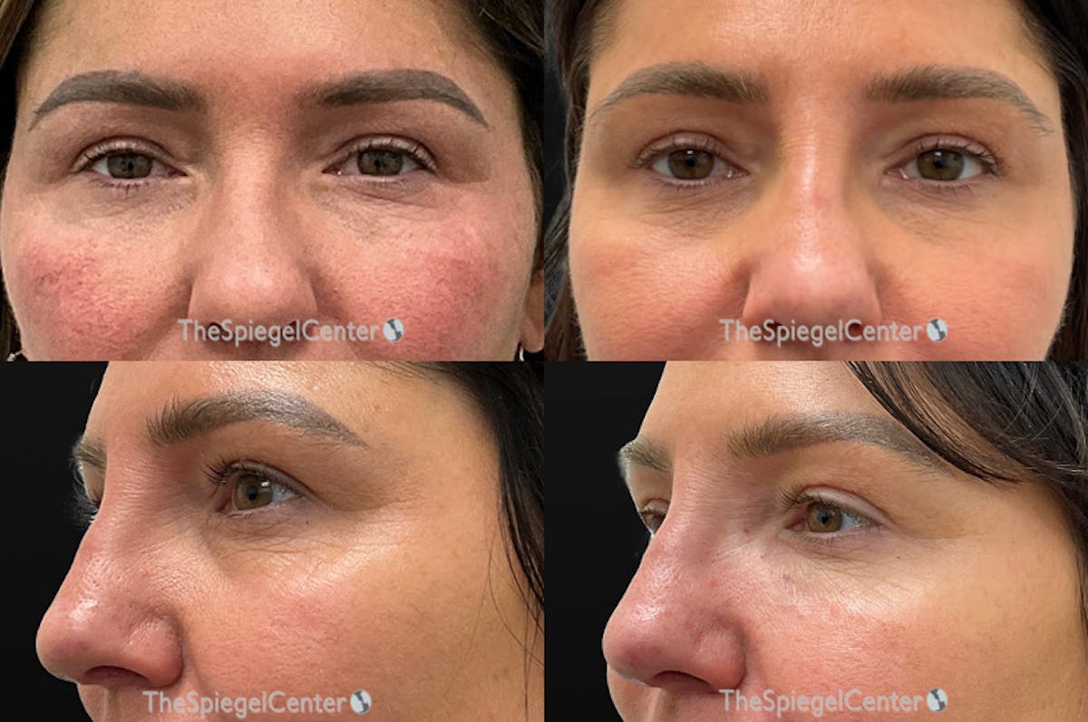 Tear Trough / Under Eye Fillers Before & After Gallery - Patient 352418 - Image 1