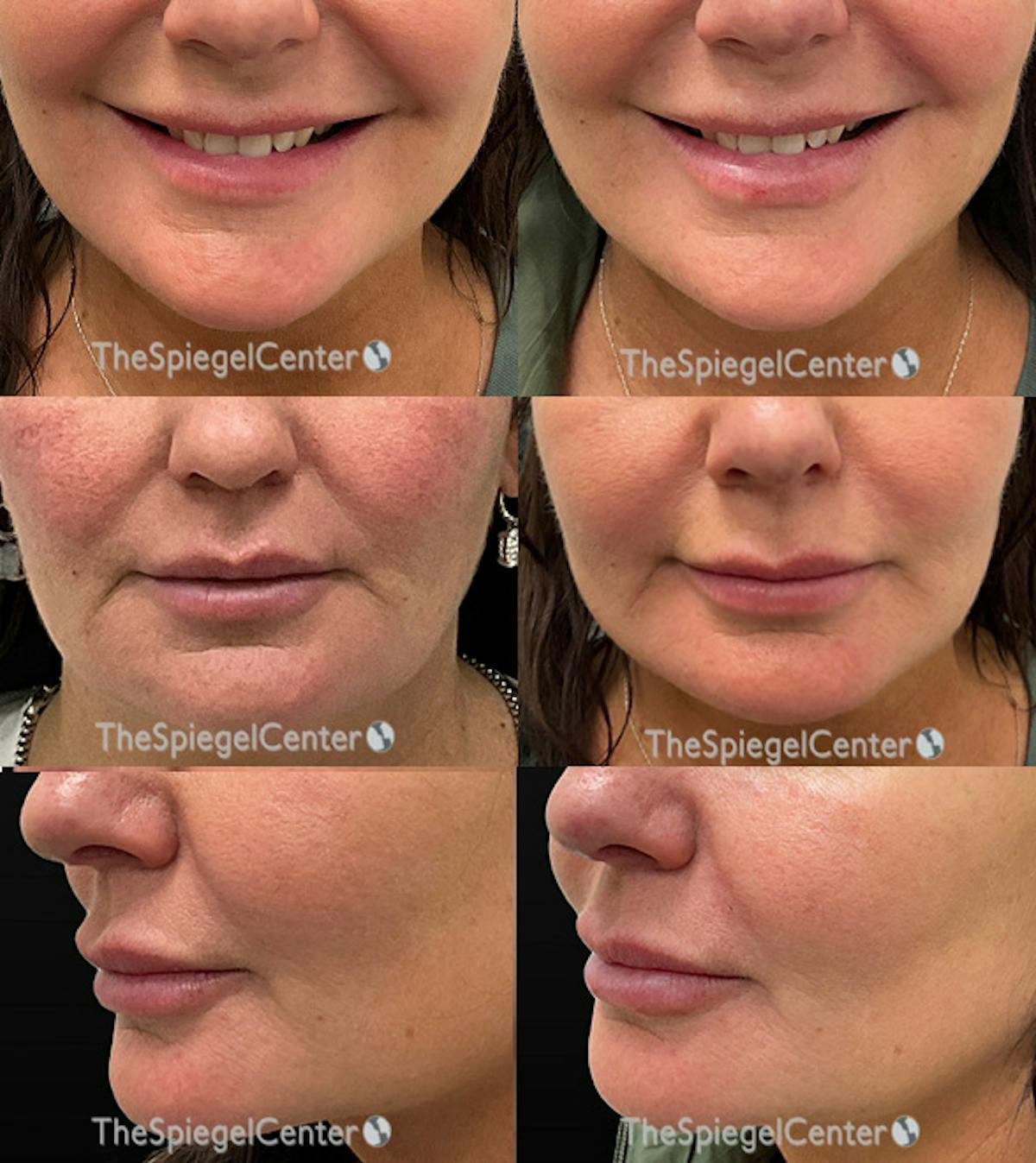 Lip Filler Before & After Gallery - Patient 380425 - Image 1