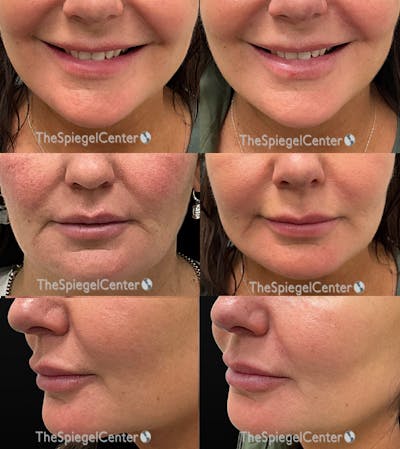Lip Filler Before & After Gallery - Patient 380425 - Image 1