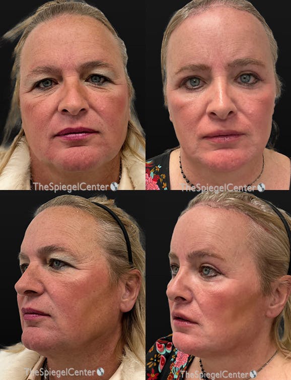 FFS Before & After Gallery - Patient 196933 - Image 1