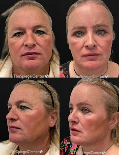 FFS Before & After Gallery - Patient 196933 - Image 1