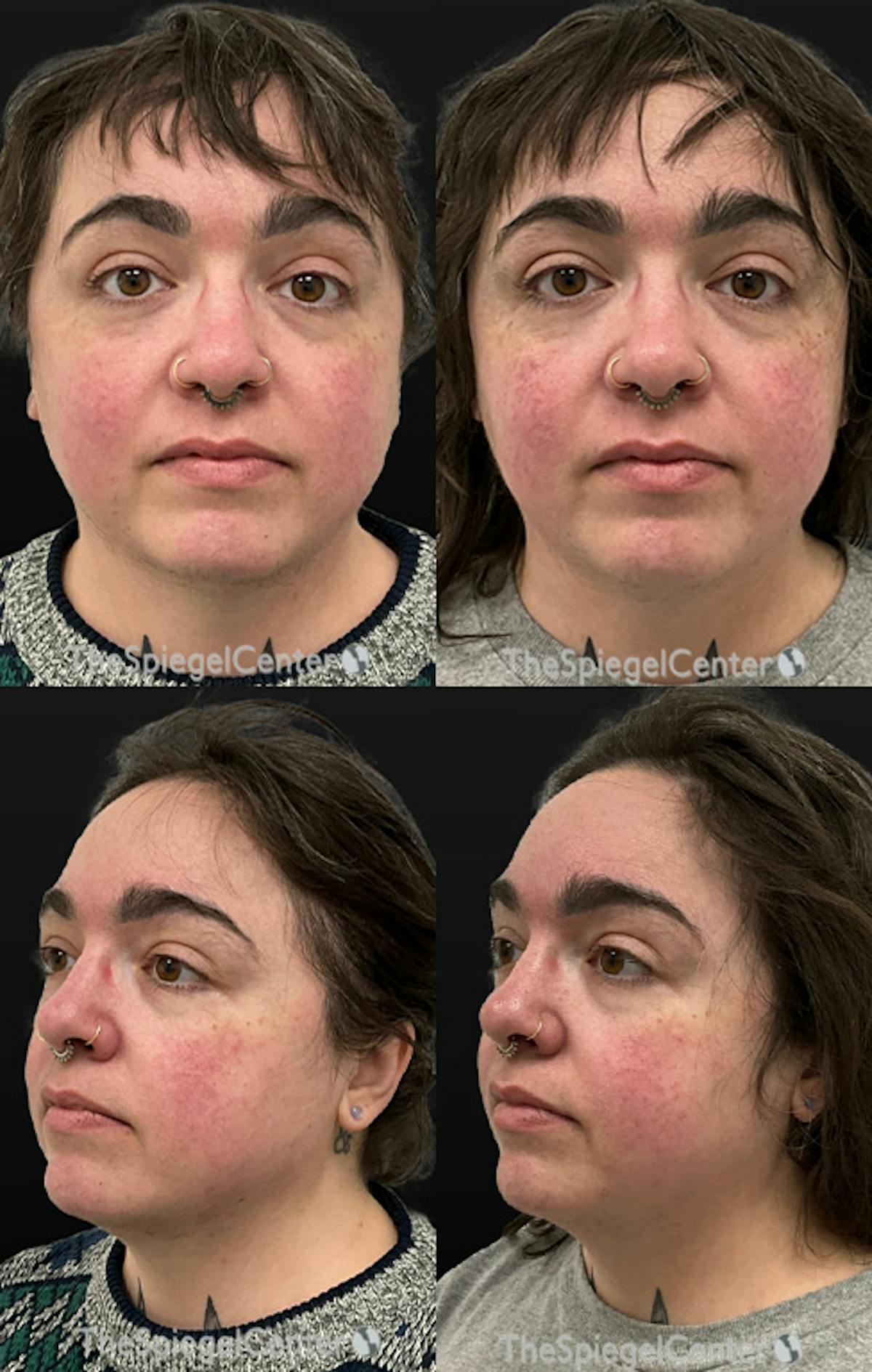 Masseter Botox Before & After Gallery - Patient 405367 - Image 1