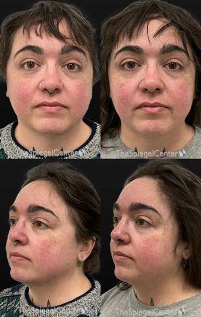 Masseter Botox Before & After Gallery - Patient 405367 - Image 1