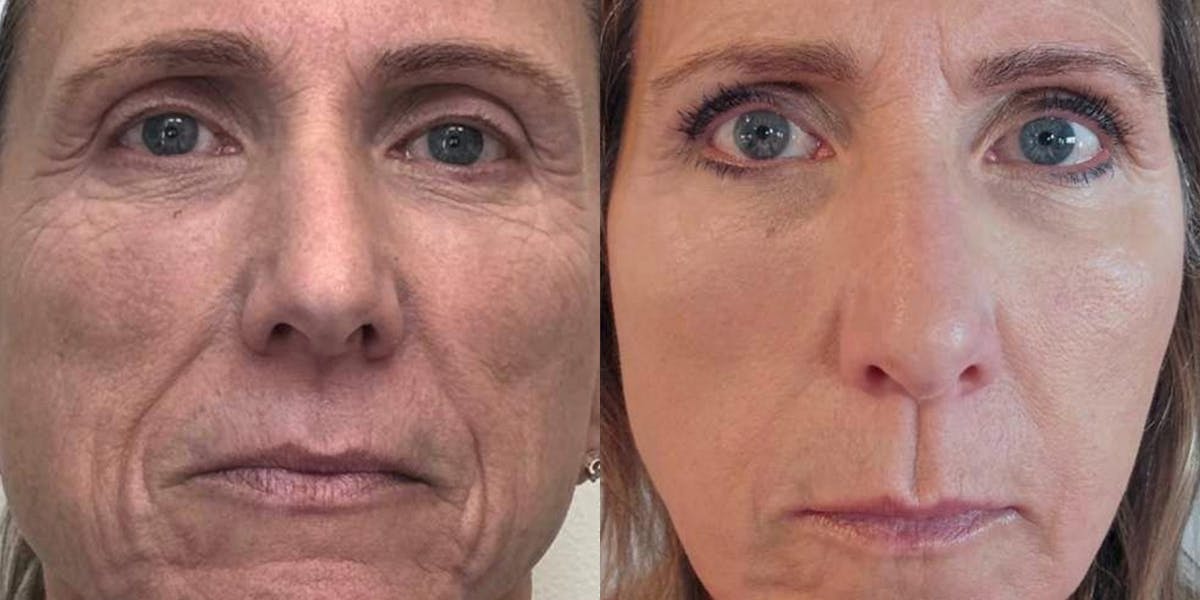 Junera Before & After Gallery - Patient 206611 - Image 1