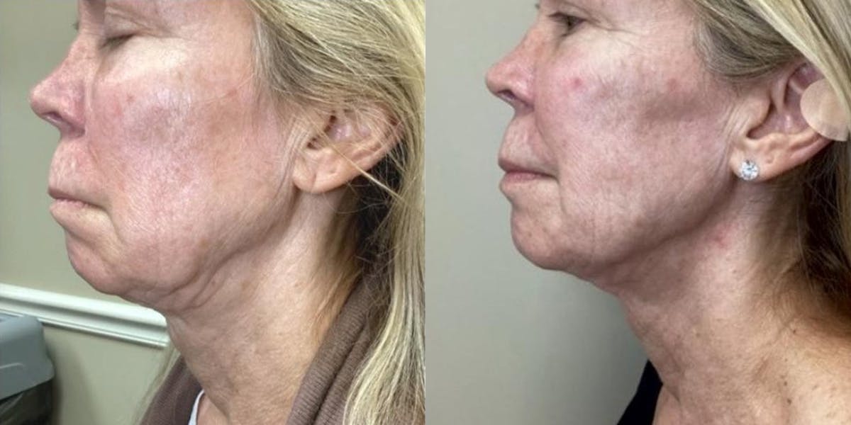 Junera Before & After Gallery - Patient 177514 - Image 1