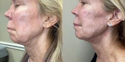 Junera Before & After Gallery - Patient 177514 - Image 1