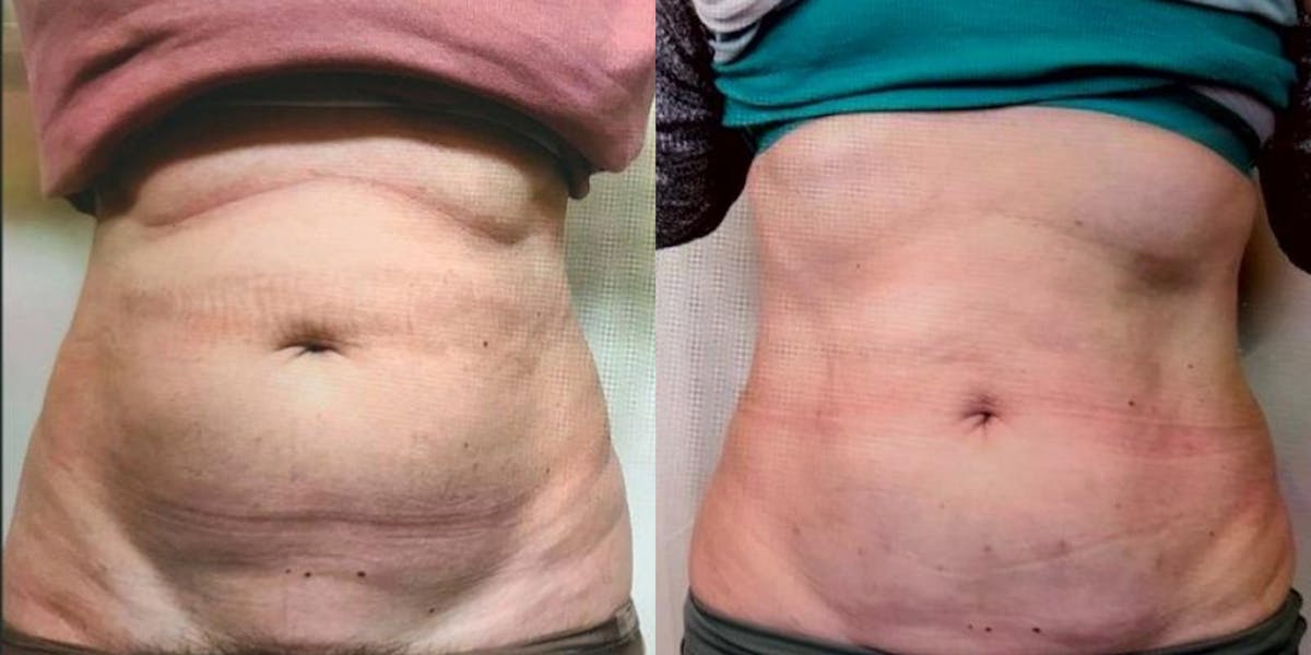 Junera Before & After Gallery - Patient 163134 - Image 1