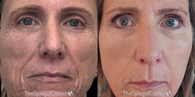 Junera Before & After Gallery - Patient 206611 - Image 1
