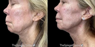 Junera Before & After Gallery - Patient 177514 - Image 1