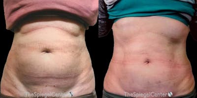 Junera Before & After Gallery - Patient 163134 - Image 1
