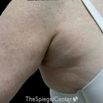 Junera Before & After Gallery - Patient 419810 - Image 1
