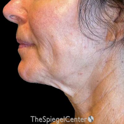 Junera Before & After Gallery - Patient 271812 - Image 1