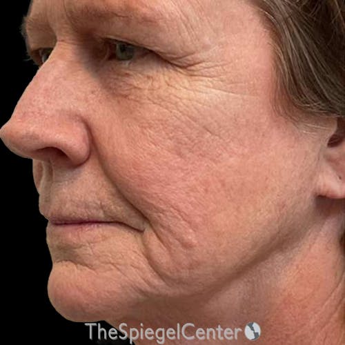 Junera Before & After Gallery - Patient 283417 - Image 1