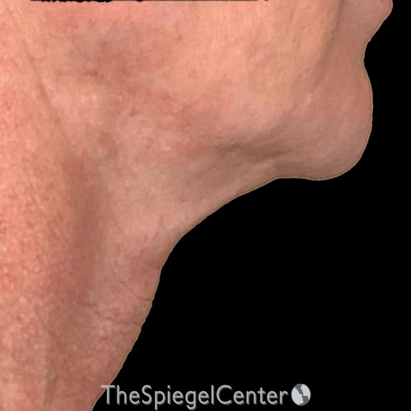 Junera Before & After Gallery - Patient 452222 - Image 1