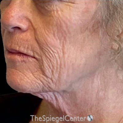 Junera Before & After Gallery - Patient 192361 - Image 1