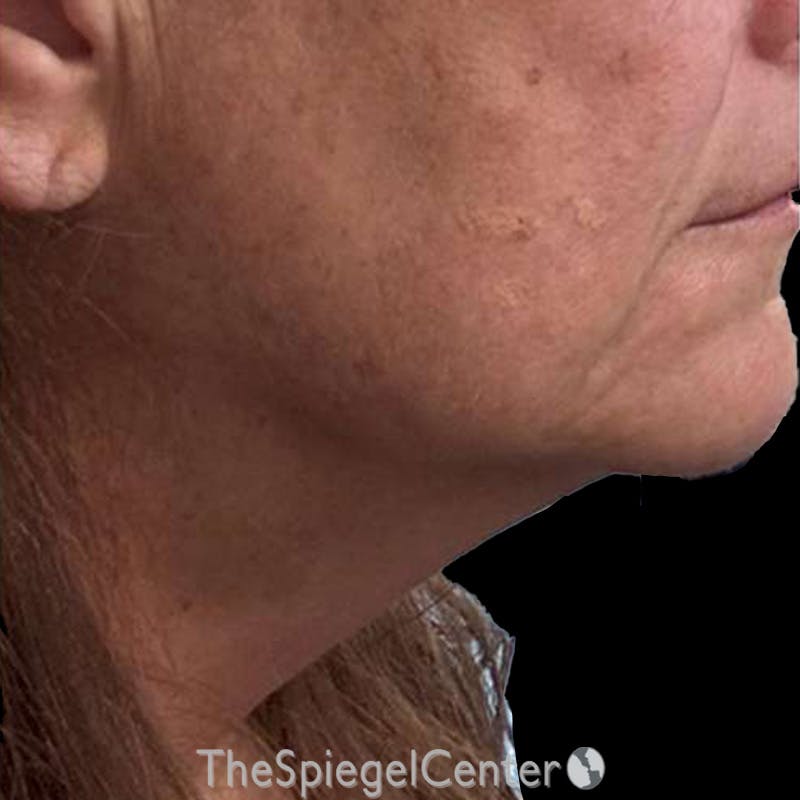 Junera Before & After Gallery - Patient 280081 - Image 2