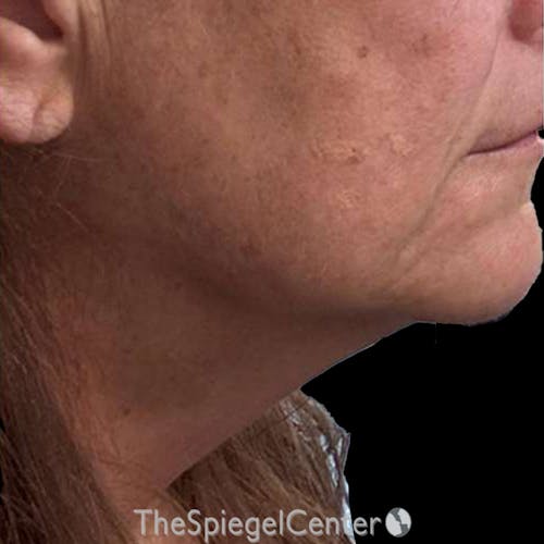 Junera Before & After Gallery - Patient 280081 - Image 2