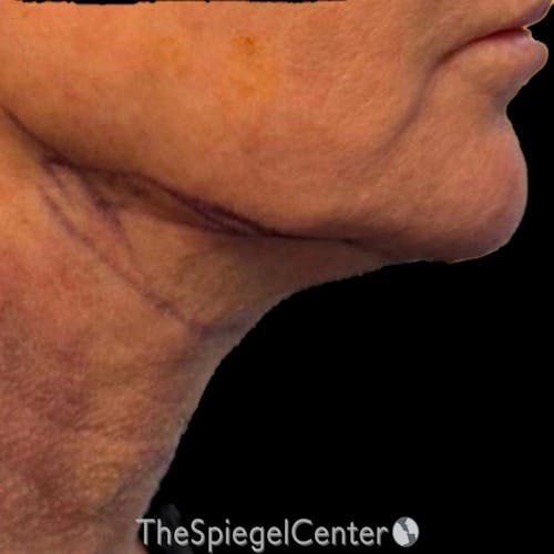 Junera Before & After Gallery - Patient 452222 - Image 2