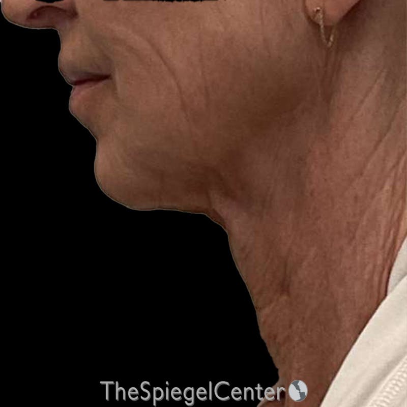 Junera Before & After Gallery - Patient 170512 - Image 1