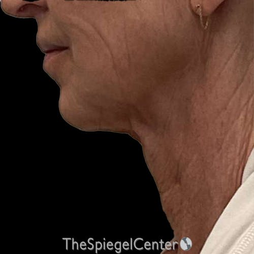 Junera Before & After Gallery - Patient 170512 - Image 1