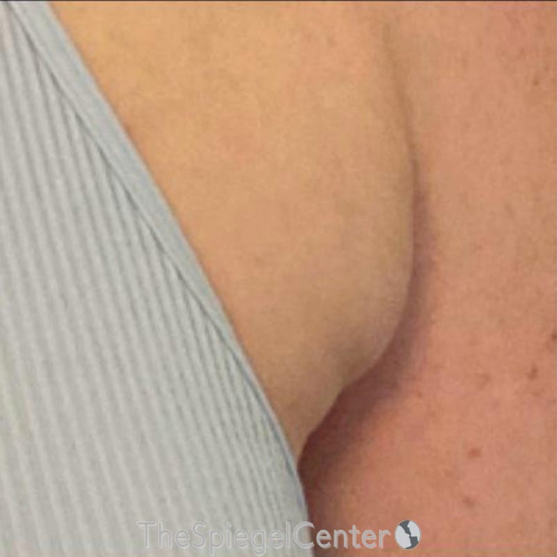 Junera Before & After Gallery - Patient 388110 - Image 1