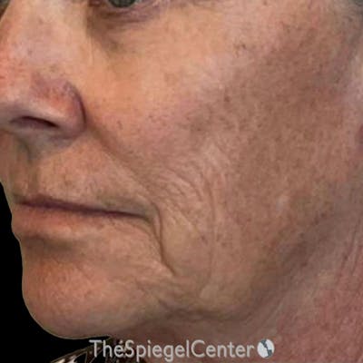Junera Before & After Gallery - Patient 427355 - Image 1