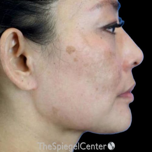 Junera Before & After Gallery - Patient 308282 - Image 1