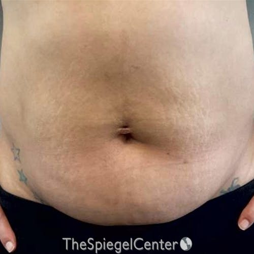 Junera Before & After Gallery - Patient 196099 - Image 1