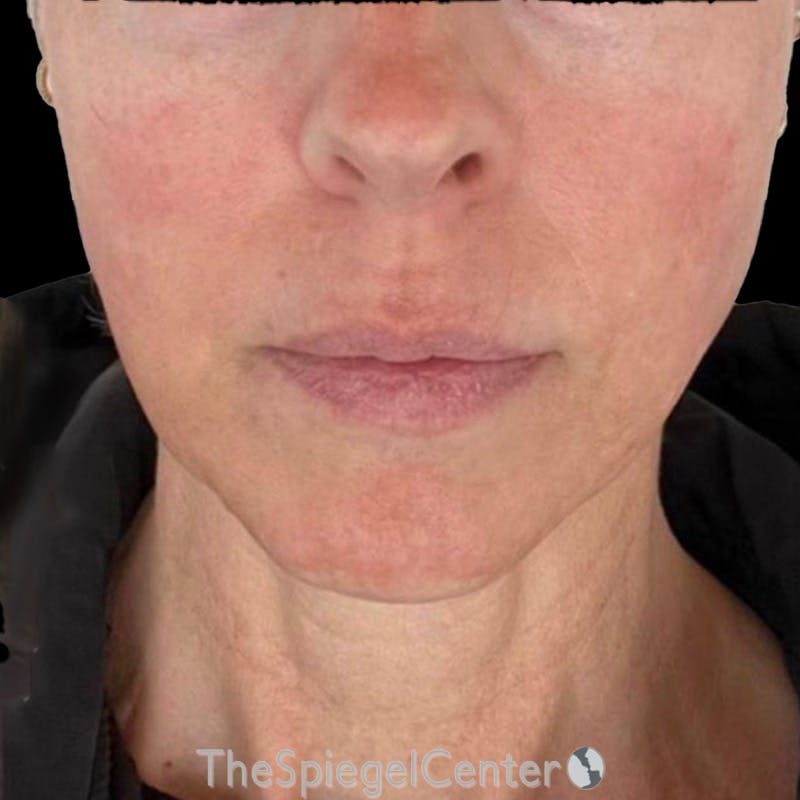 Junera Before & After Gallery - Patient 239418 - Image 2