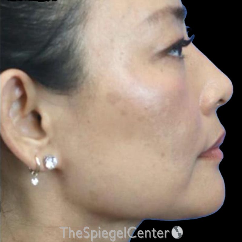 Junera Before & After Gallery - Patient 308282 - Image 2