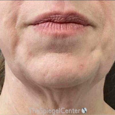 Junera Before & After Gallery - Patient 563833 - Image 1