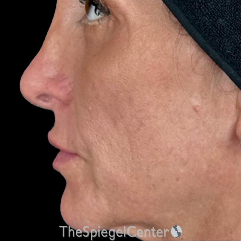 Junera Before & After Gallery - Patient 367109 - Image 1