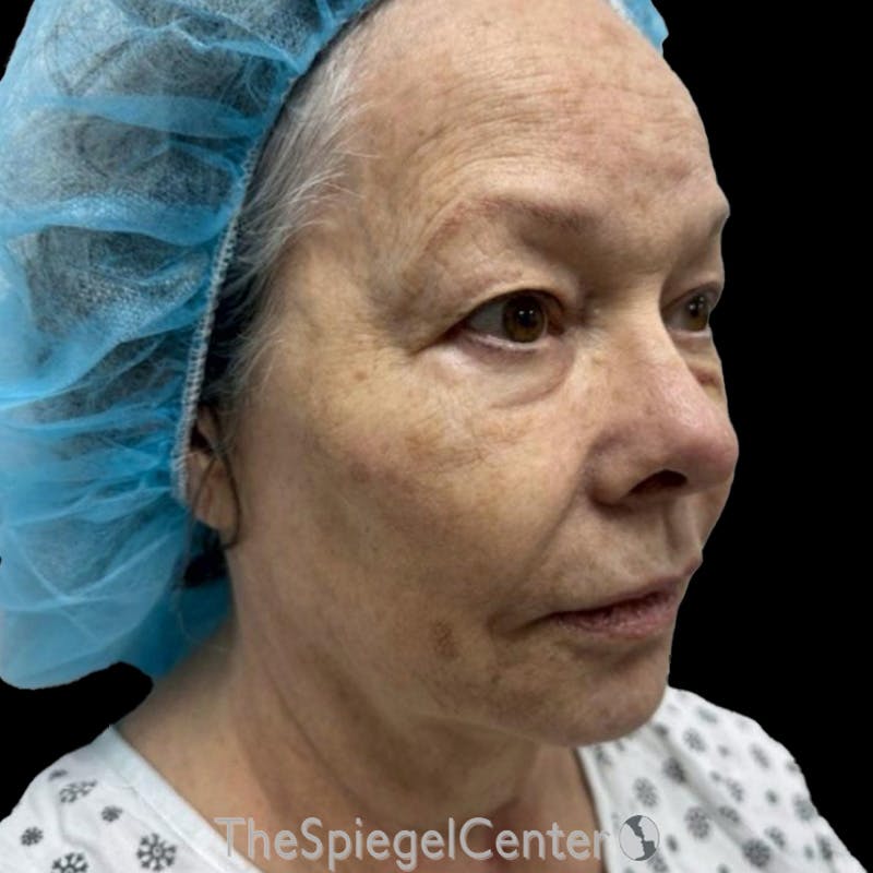 Junera Before & After Gallery - Patient 187506 - Image 1