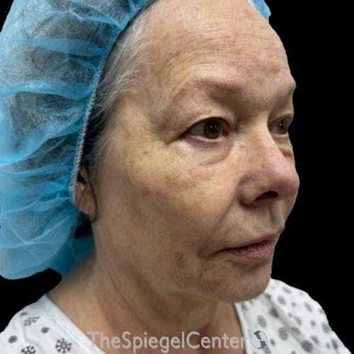 Junera Before & After Gallery - Patient 187506 - Image 1
