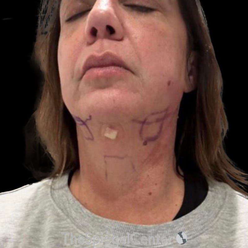 Junera Before & After Gallery - Patient 511811 - Image 2