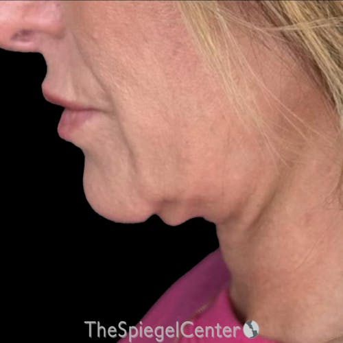 Junera Before & After Gallery - Patient 433316 - Image 2