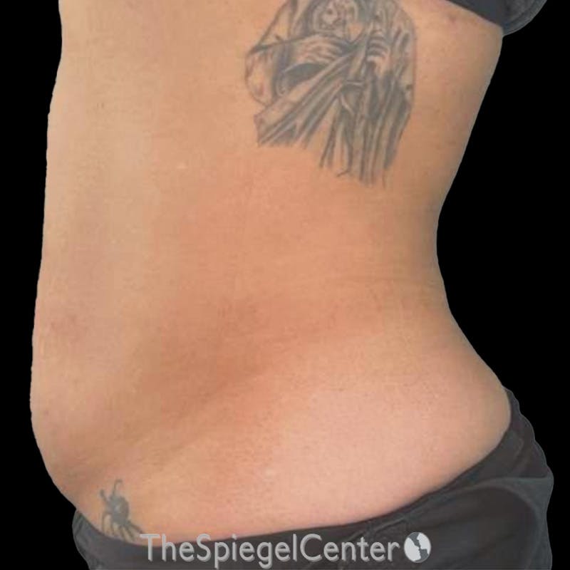 Junera Before & After Gallery - Patient 317227 - Image 2