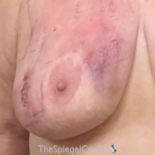Junera Before & After Gallery - Patient 171643 - Image 2