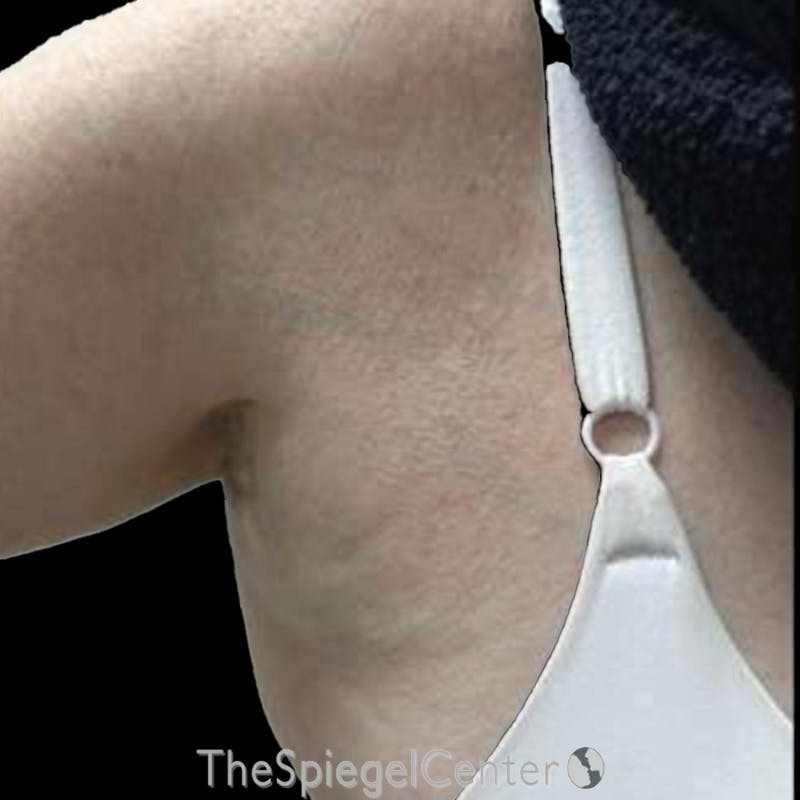 Junera Before & After Gallery - Patient 292500 - Image 2